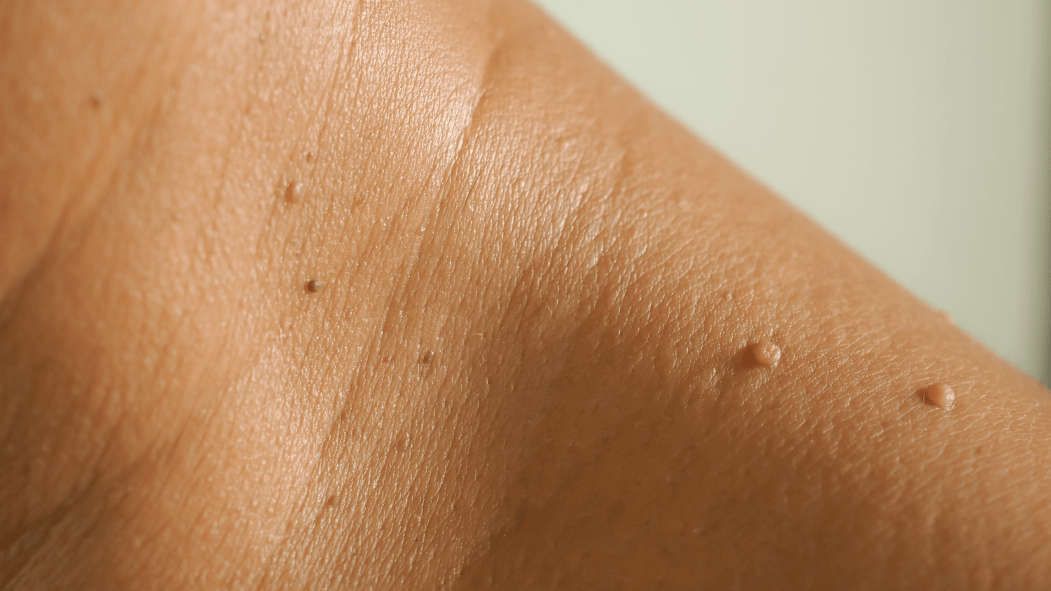 Skin Tags: Everything You Need to Know