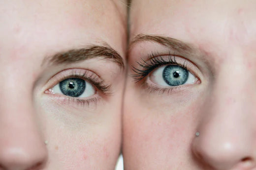 Using A Plasma Pen Under Eye Bags: What You Need To Know